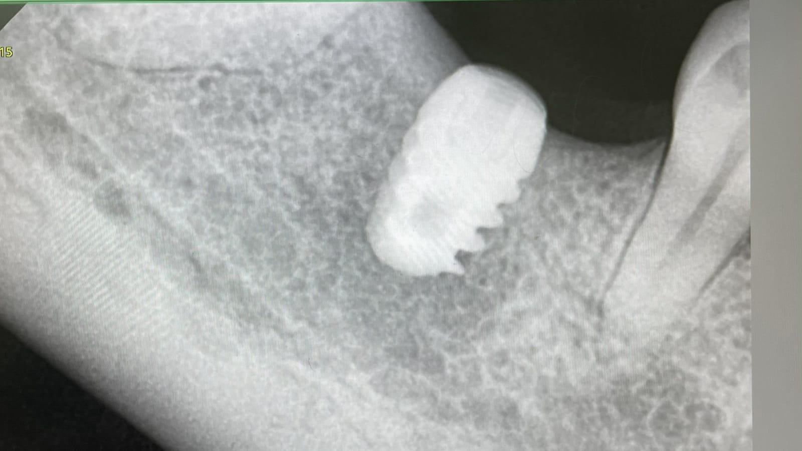 A dental X-ray showing an implant screw in the jawbone